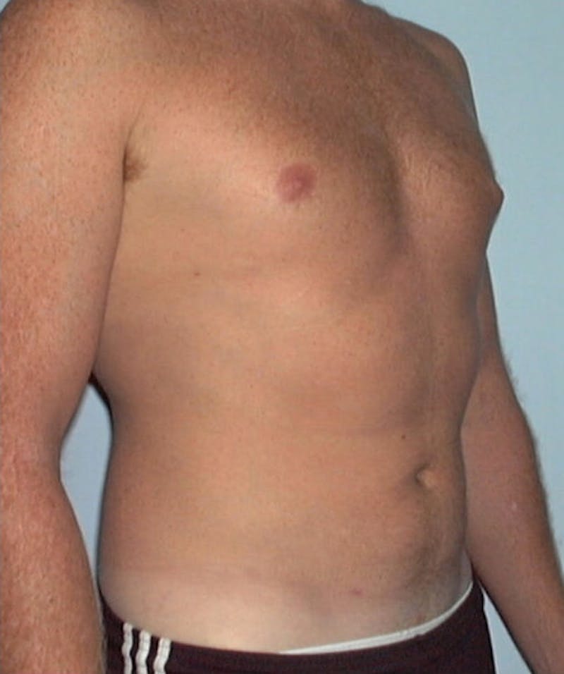 Liposuction Before & After Gallery - Patient 133023792 - Image 4