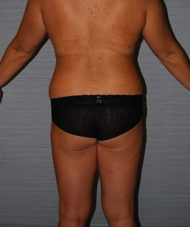 Tummy Tuck Before & After Gallery - Patient 133023791 - Image 5