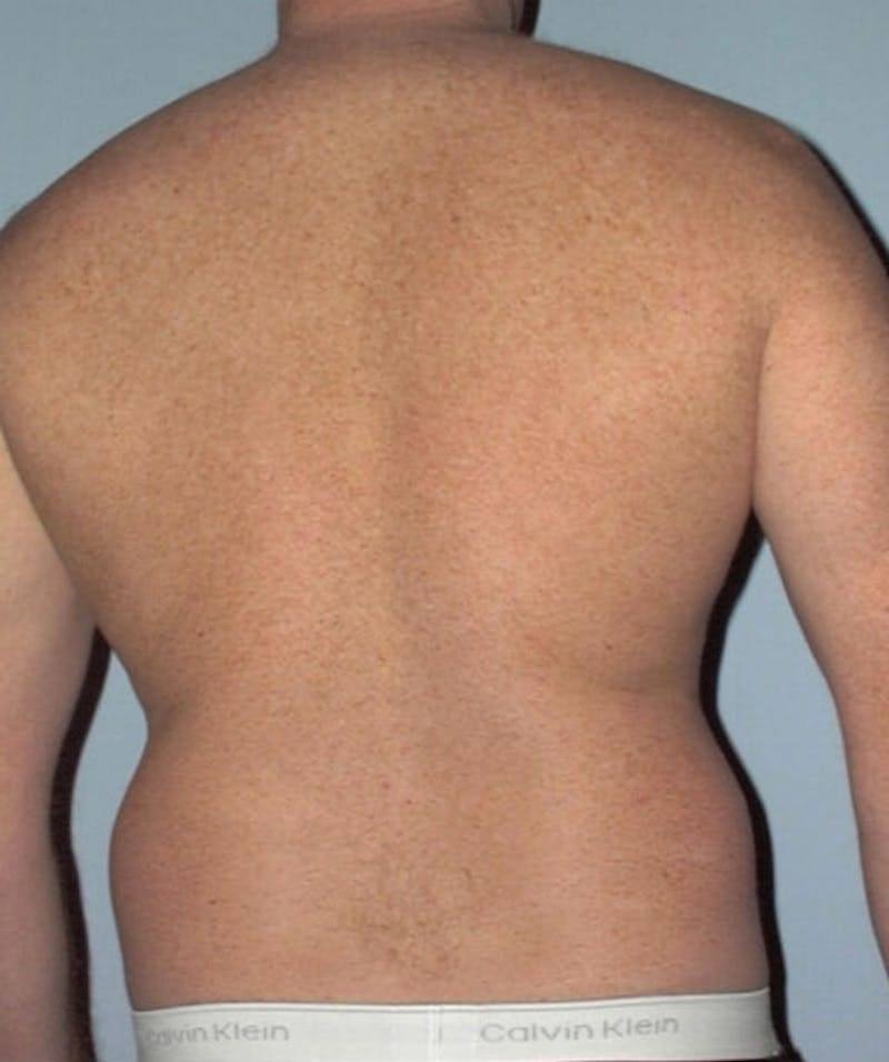 Liposuction Before & After Gallery - Patient 133023792 - Image 5