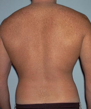 Liposuction Before & After Gallery - Patient 133023792 - Image 6
