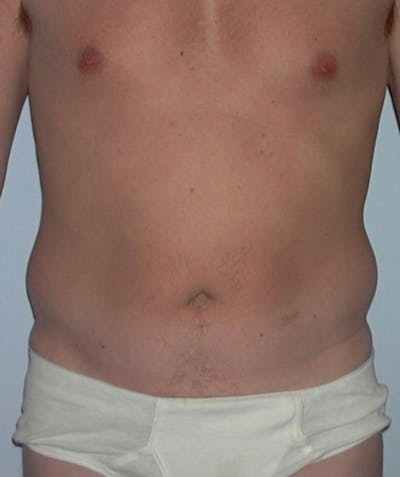 Liposuction Before & After Gallery - Patient 133023793 - Image 1