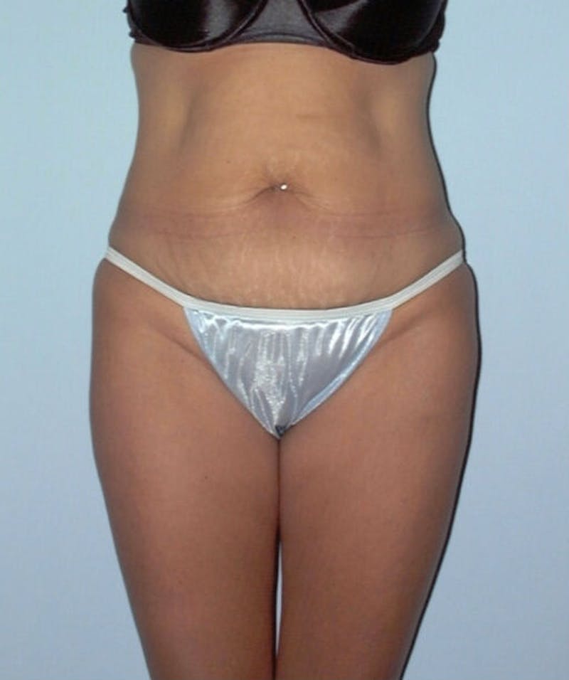 Tummy Tuck Before & After Gallery - Patient 133023795 - Image 1