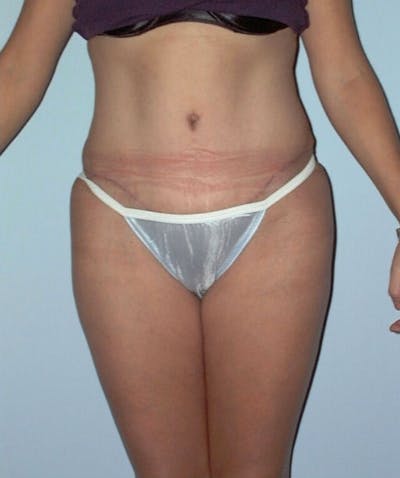 Tummy Tuck Before & After Gallery - Patient 133023795 - Image 2