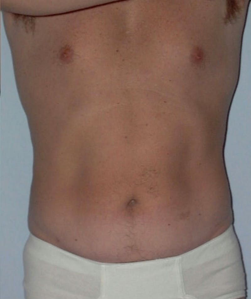 Liposuction Before & After Gallery - Patient 133023793 - Image 2