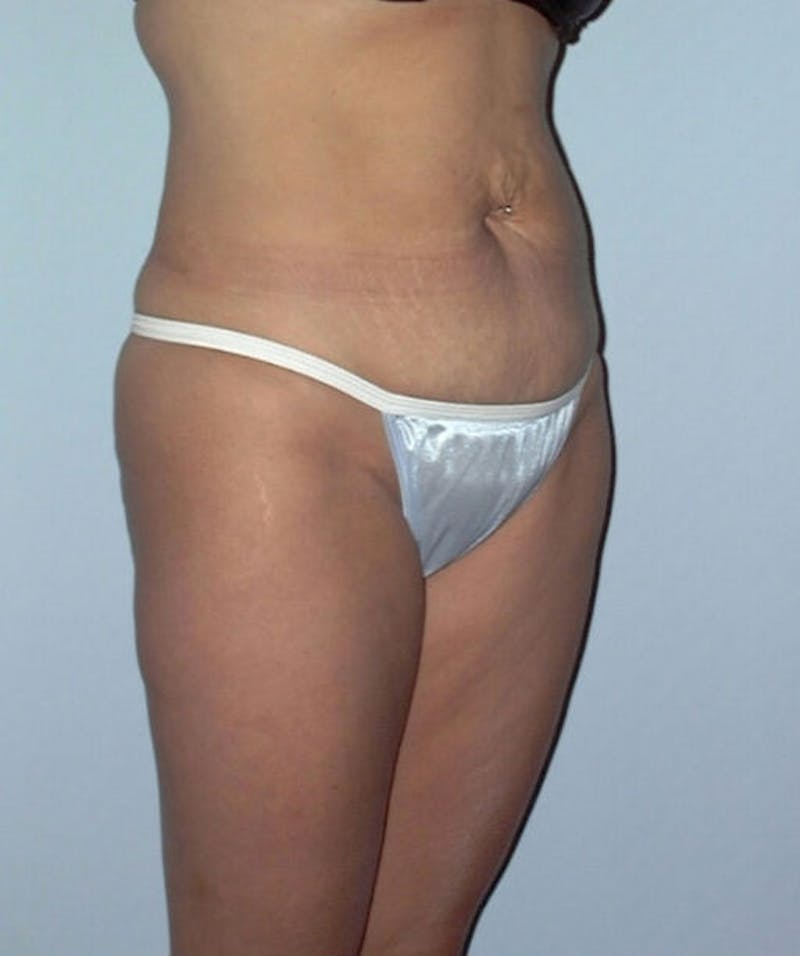 Tummy Tuck Before & After Gallery - Patient 133023795 - Image 3