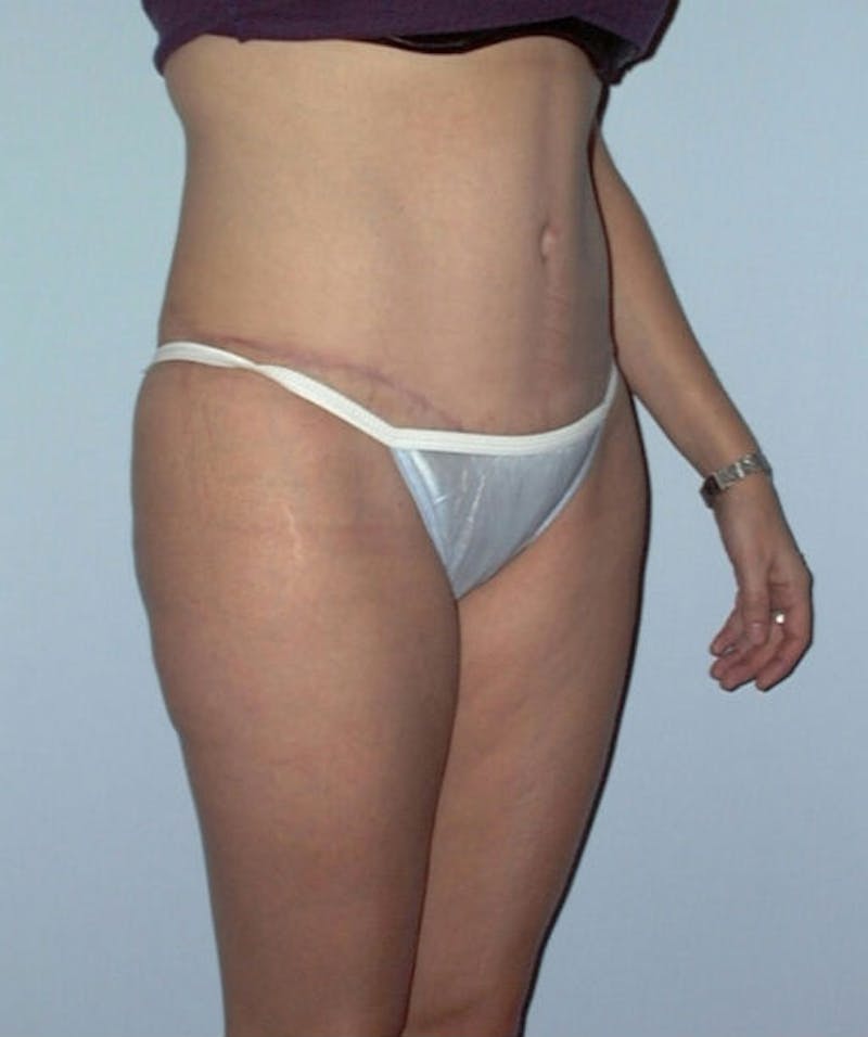 Tummy Tuck Before & After Gallery - Patient 133023795 - Image 4
