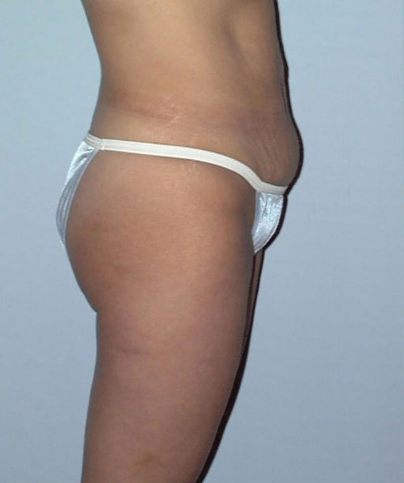 Tummy Tuck Before & After Gallery - Patient 133023795 - Image 5