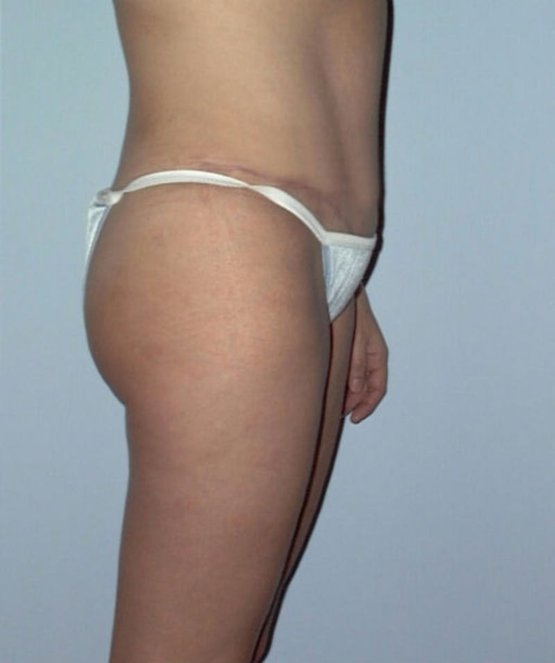 Tummy Tuck Before & After Gallery - Patient 133023795 - Image 6