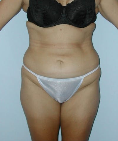 Tummy Tuck Before & After Gallery - Patient 133023809 - Image 1