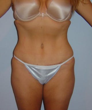 Tummy Tuck Before & After Gallery - Patient 133023809 - Image 2