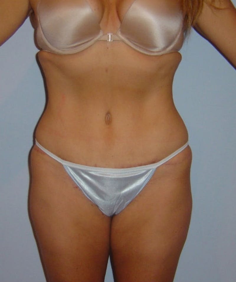 Tummy Tuck Before & After Gallery - Patient 133023809 - Image 2