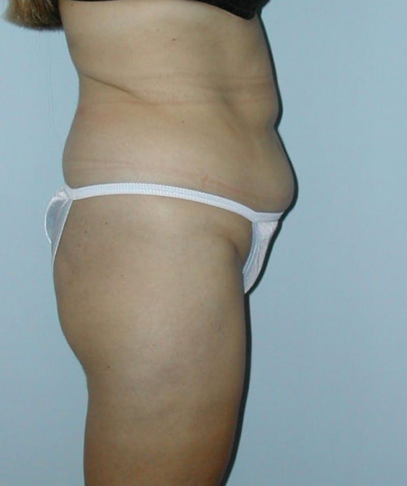 Tummy Tuck Before & After Gallery - Patient 133023809 - Image 3