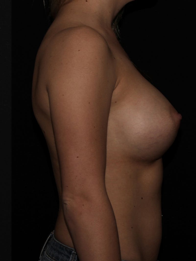 Breast Augmentation Before & After Gallery - Patient 133023808 - Image 8
