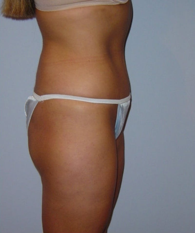 Tummy Tuck Before & After Gallery - Patient 133023809 - Image 4