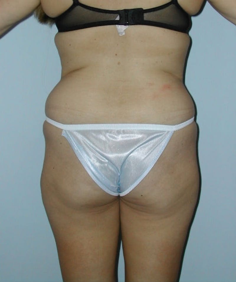 Tummy Tuck Before & After Gallery - Patient 133023809 - Image 5