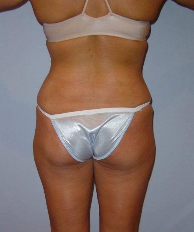 Tummy Tuck Before & After Gallery - Patient 133023809 - Image 6