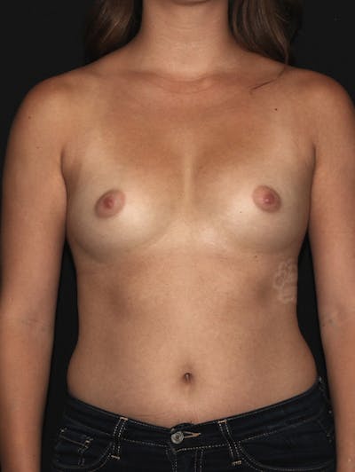 Breast Augmentation Before & After Gallery - Patient 133023820 - Image 1