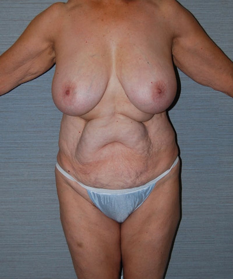 Tummy Tuck Before & After Gallery - Patient 133023811 - Image 1