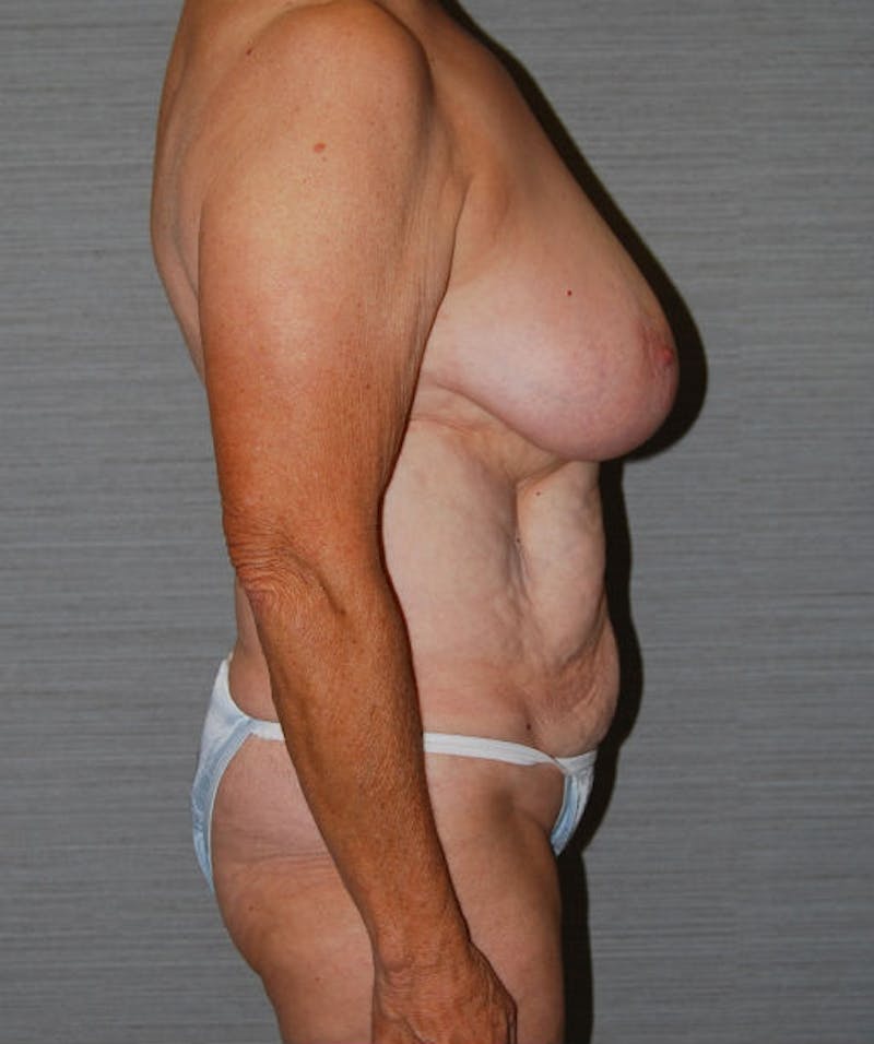 Tummy Tuck Before & After Gallery - Patient 133023811 - Image 5