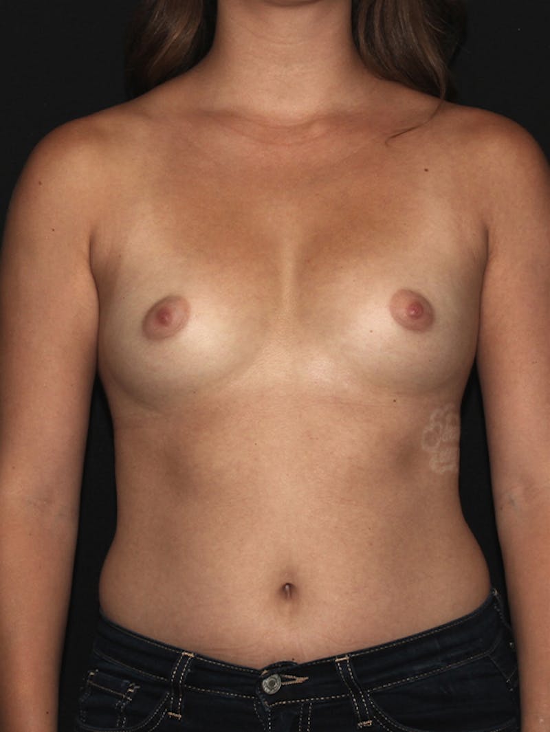 Breast Augmentation Before & After Gallery - Patient 133023820 - Image 5