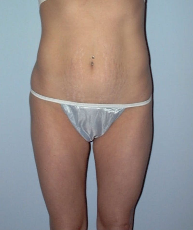 Tummy Tuck Before & After Gallery - Patient 133023819 - Image 1