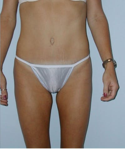 Tummy Tuck Before & After Gallery - Patient 133023819 - Image 2
