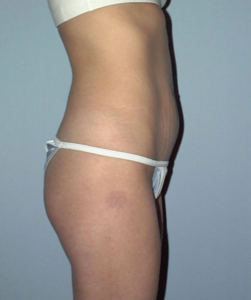 Tummy Tuck Before & After Gallery - Patient 133023819 - Image 5