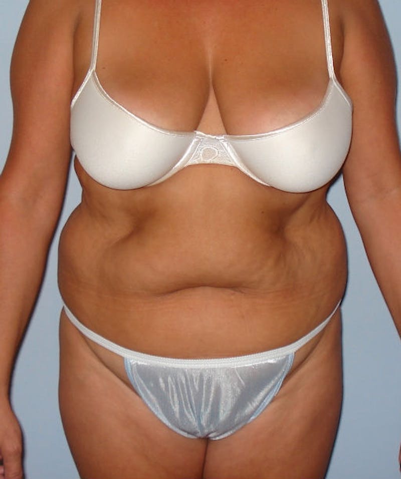 Tummy Tuck Before & After Gallery - Patient 133023831 - Image 1