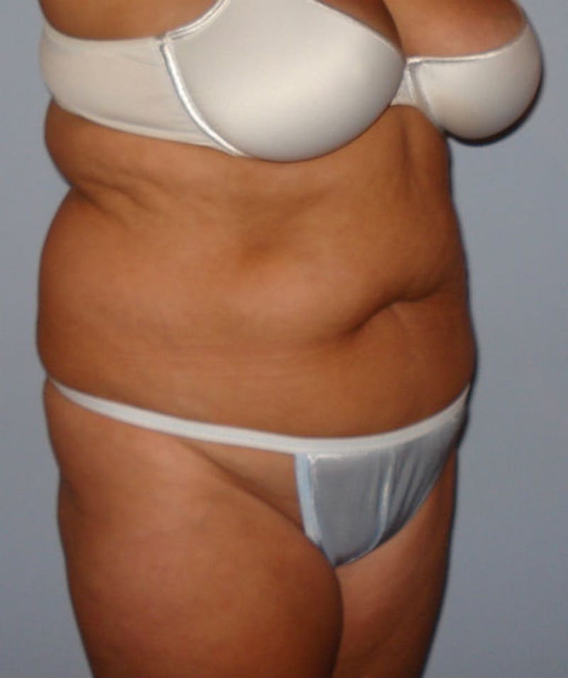 Tummy Tuck Before & After Gallery - Patient 133023831 - Image 3