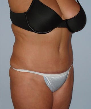 Tummy Tuck Before & After Gallery - Patient 133023831 - Image 4