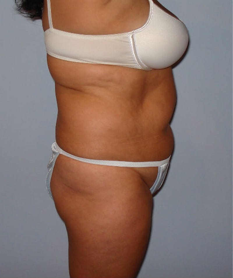 Tummy Tuck Before & After Gallery - Patient 133023831 - Image 5
