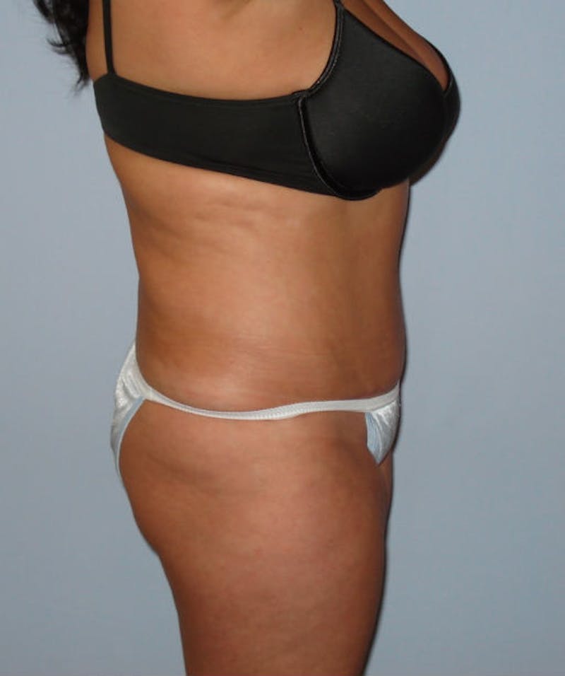 Tummy Tuck Before & After Gallery - Patient 133023831 - Image 6
