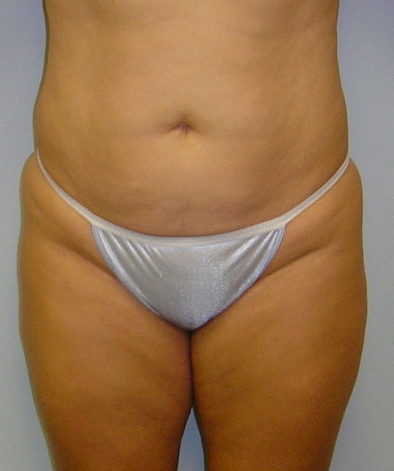 Tummy Tuck Before & After Gallery - Patient 133023839 - Image 1