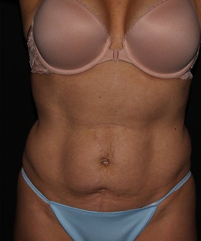Liposuction Before & After Gallery - Patient 133023845 - Image 1