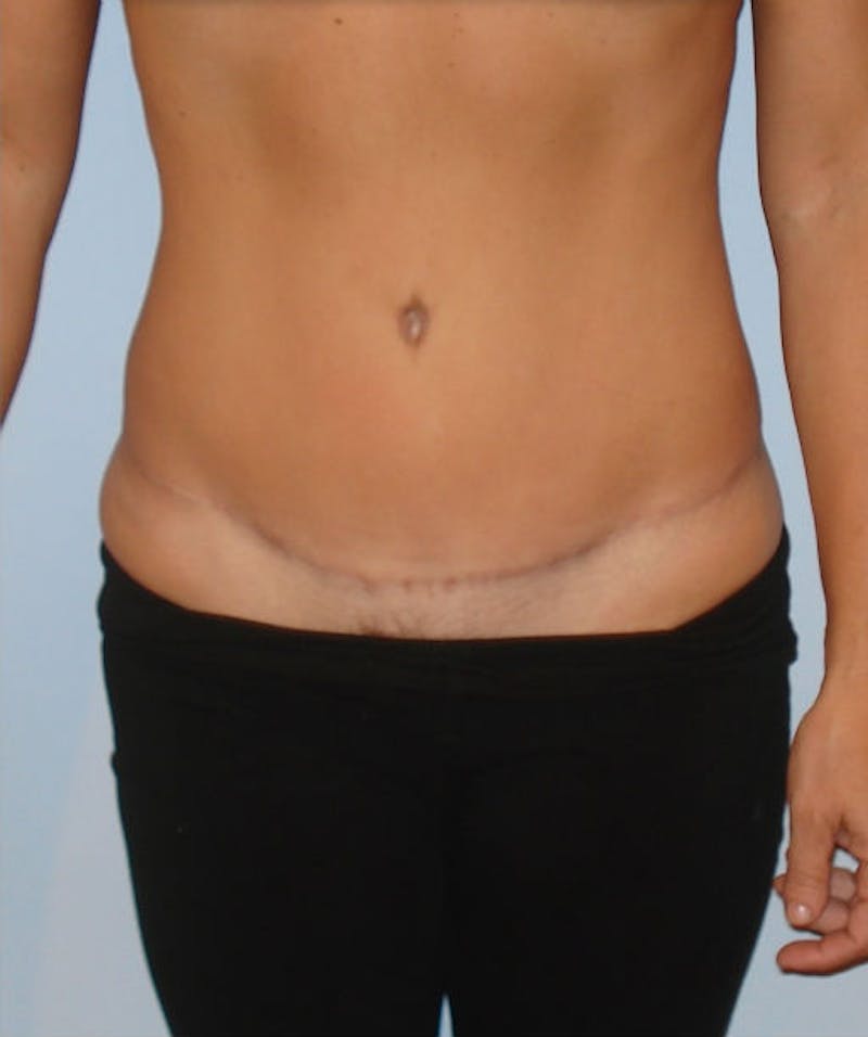 Tummy Tuck Before & After Gallery - Patient 133023839 - Image 2