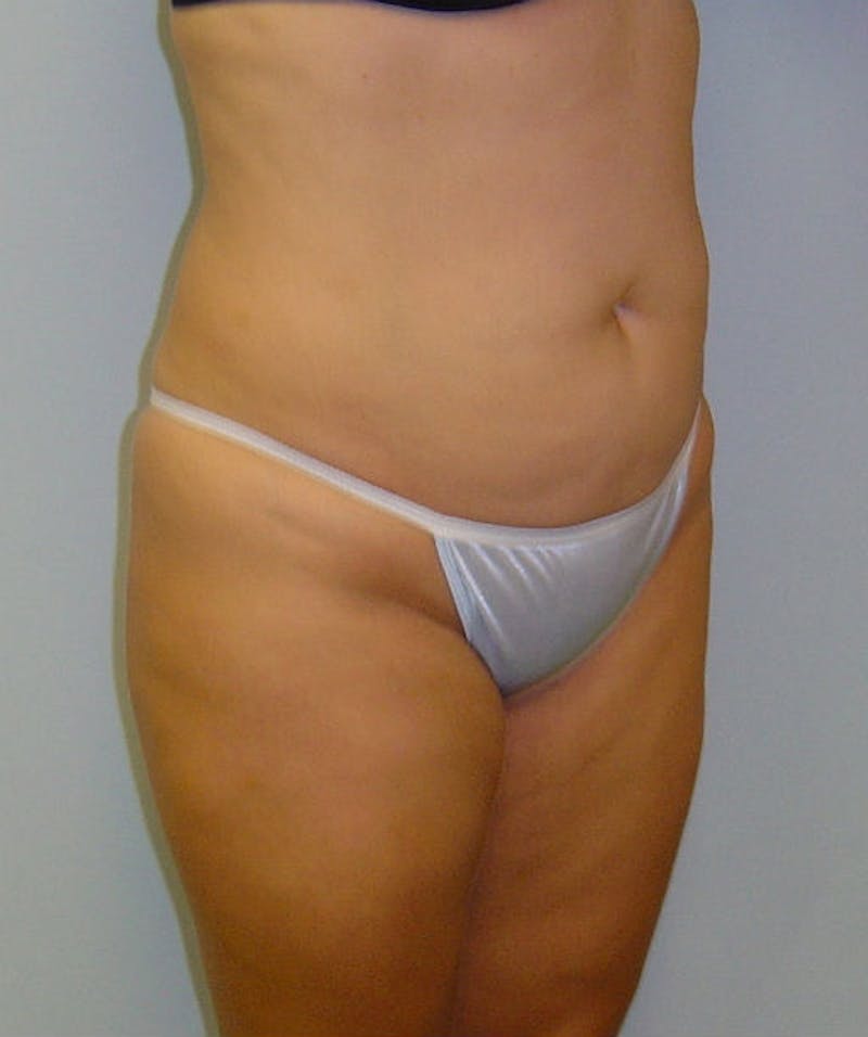 Tummy Tuck Before & After Gallery - Patient 133023839 - Image 3