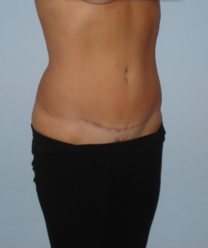 Tummy Tuck Before & After Gallery - Patient 133023839 - Image 4