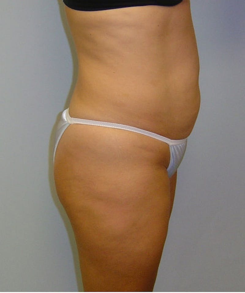 Tummy Tuck Before & After Gallery - Patient 133023839 - Image 5