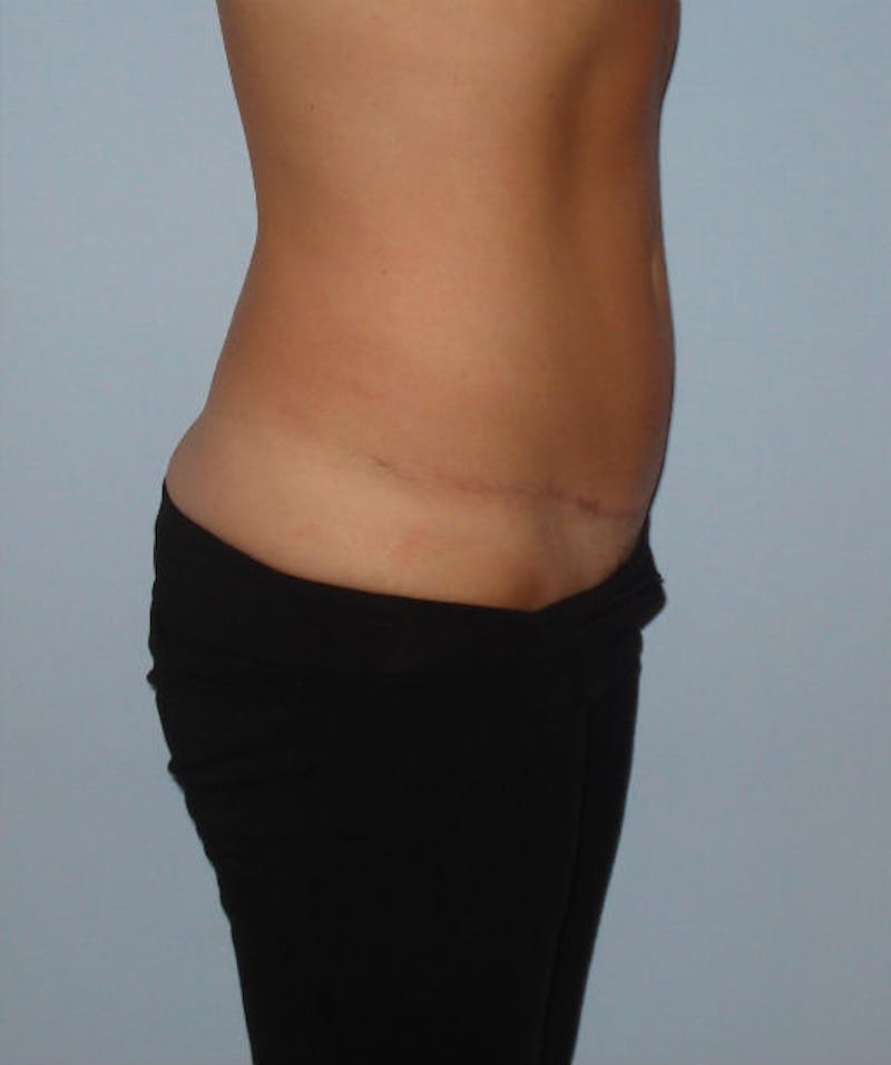 Tummy Tuck Before & After Gallery - Patient 133023839 - Image 6