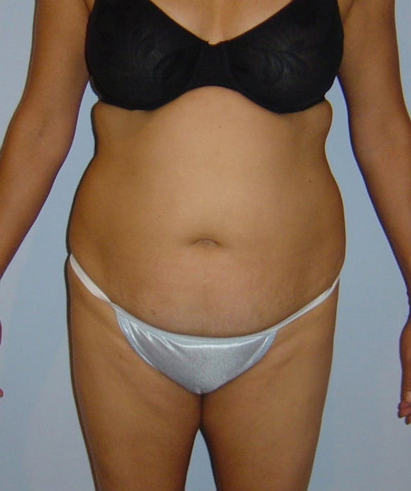 Tummy Tuck Before & After Gallery - Patient 133023842 - Image 1