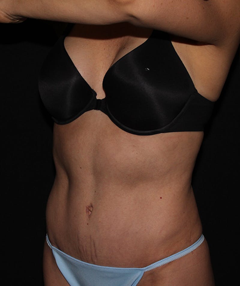 Liposuction Before & After Gallery - Patient 133023845 - Image 6