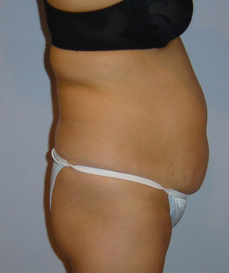 Tummy Tuck Before & After Gallery - Patient 133023842 - Image 3