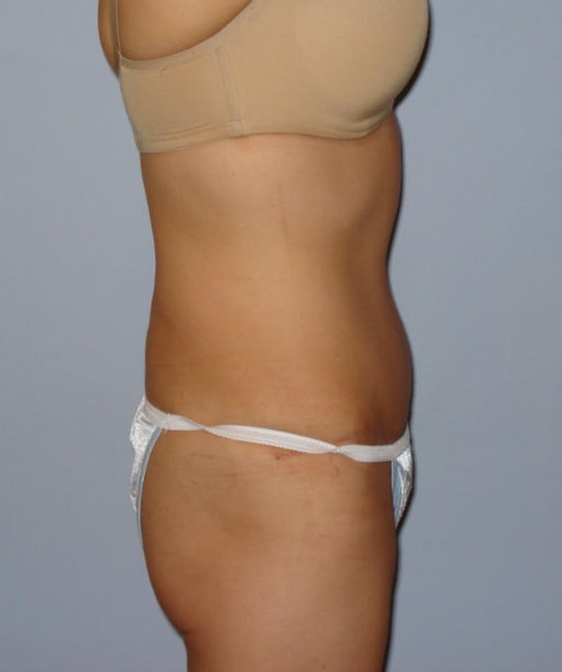 Tummy Tuck Before & After Gallery - Patient 133023842 - Image 4