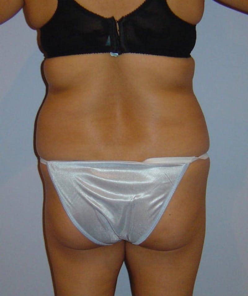 Tummy Tuck Before & After Gallery - Patient 133023842 - Image 5