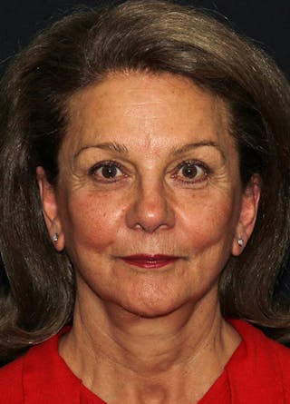 Brow Lift Before & After Gallery - Patient 133023850 - Image 2