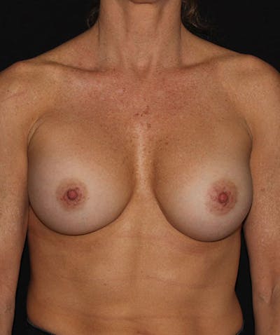 Breast Augmentation Before & After Gallery - Patient 133023851 - Image 2