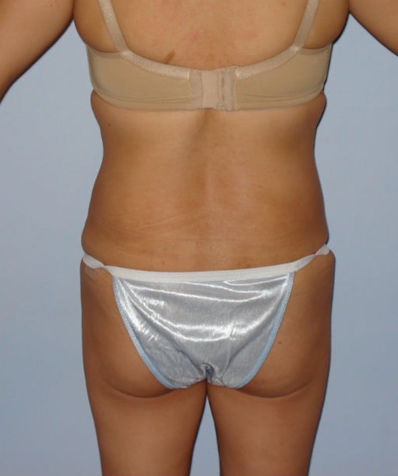Tummy Tuck Before & After Gallery - Patient 133023842 - Image 6