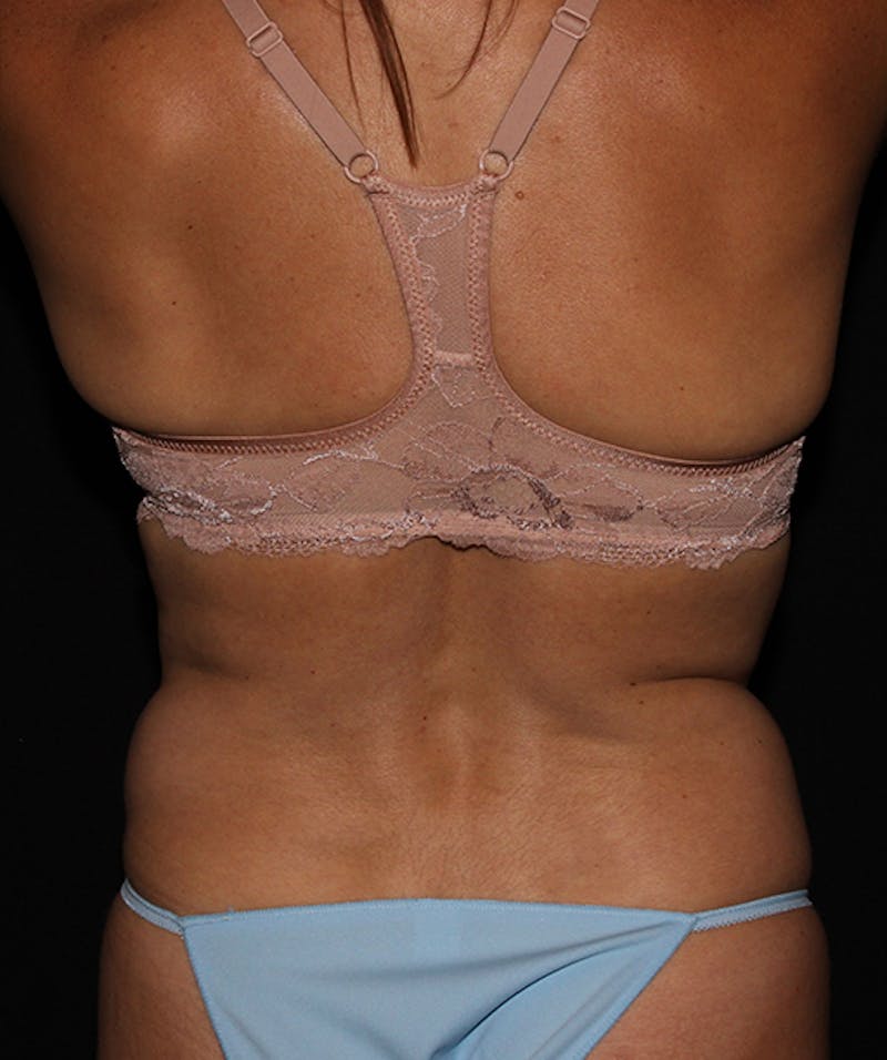 Liposuction Before & After Gallery - Patient 133023845 - Image 9