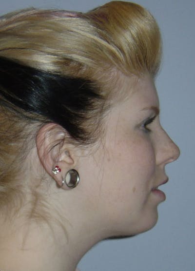 Chin Implants Before & After Gallery - Patient 133023846 - Image 2