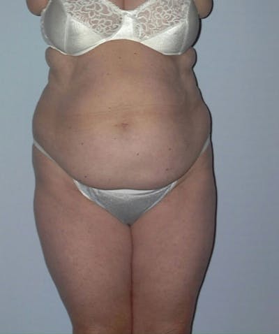 Tummy Tuck Before & After Gallery - Patient 133023849 - Image 1